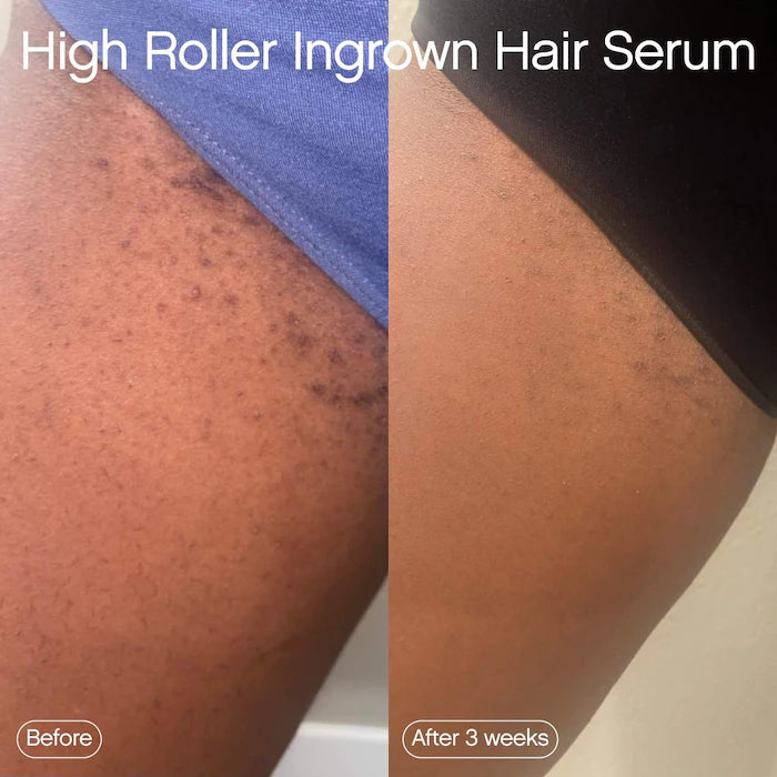 Ingrown Hair Tonic