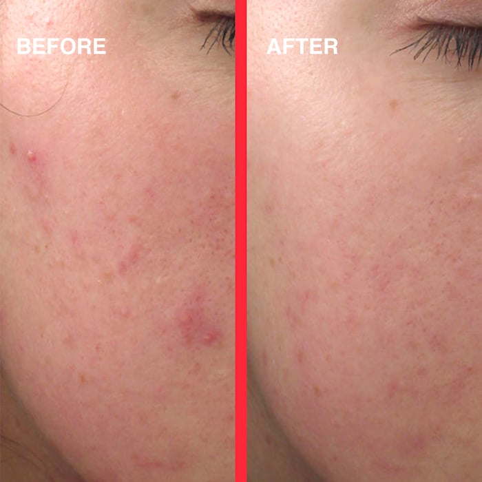 Acne Light Shot