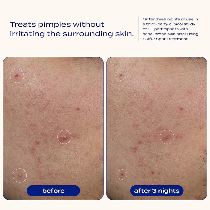 Sulfur Spot Treatment