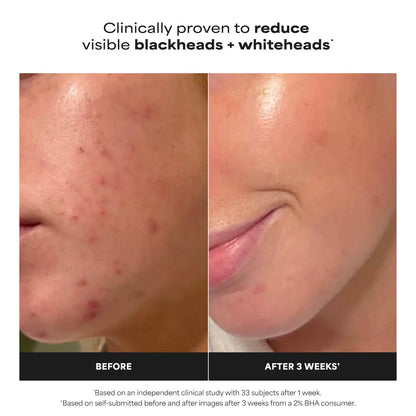 Skin Perfecting 2% BHA Exfoliating Toner for Clear Skin