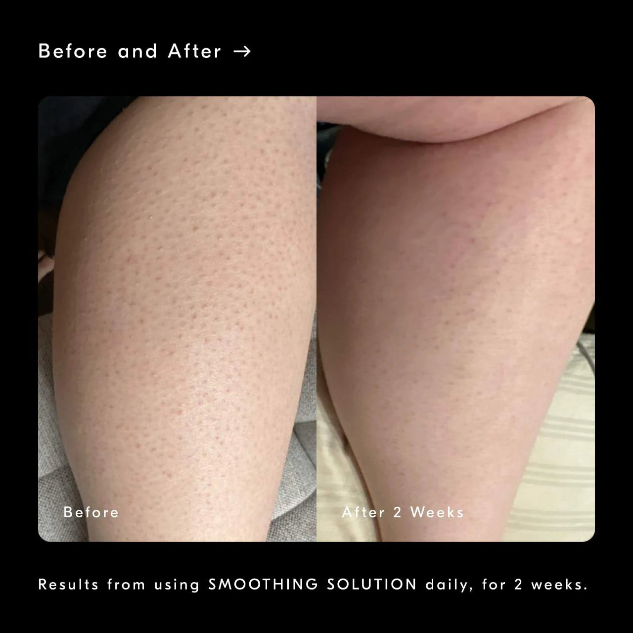 Smoothing Solution AHA Chemical Peel Body Exfoliator
