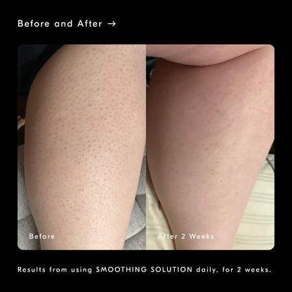 Smoothing Solution AHA Chemical Peel Body Exfoliator
