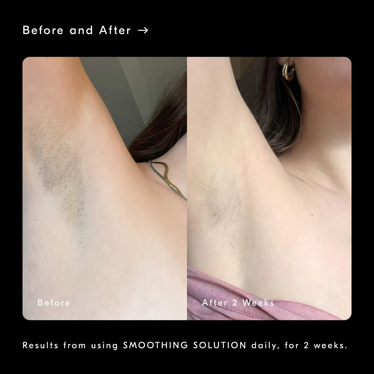 Smoothing Solution AHA Chemical Peel Body Exfoliator