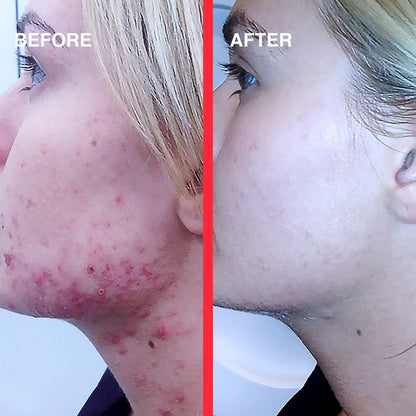 Acne Light Shot