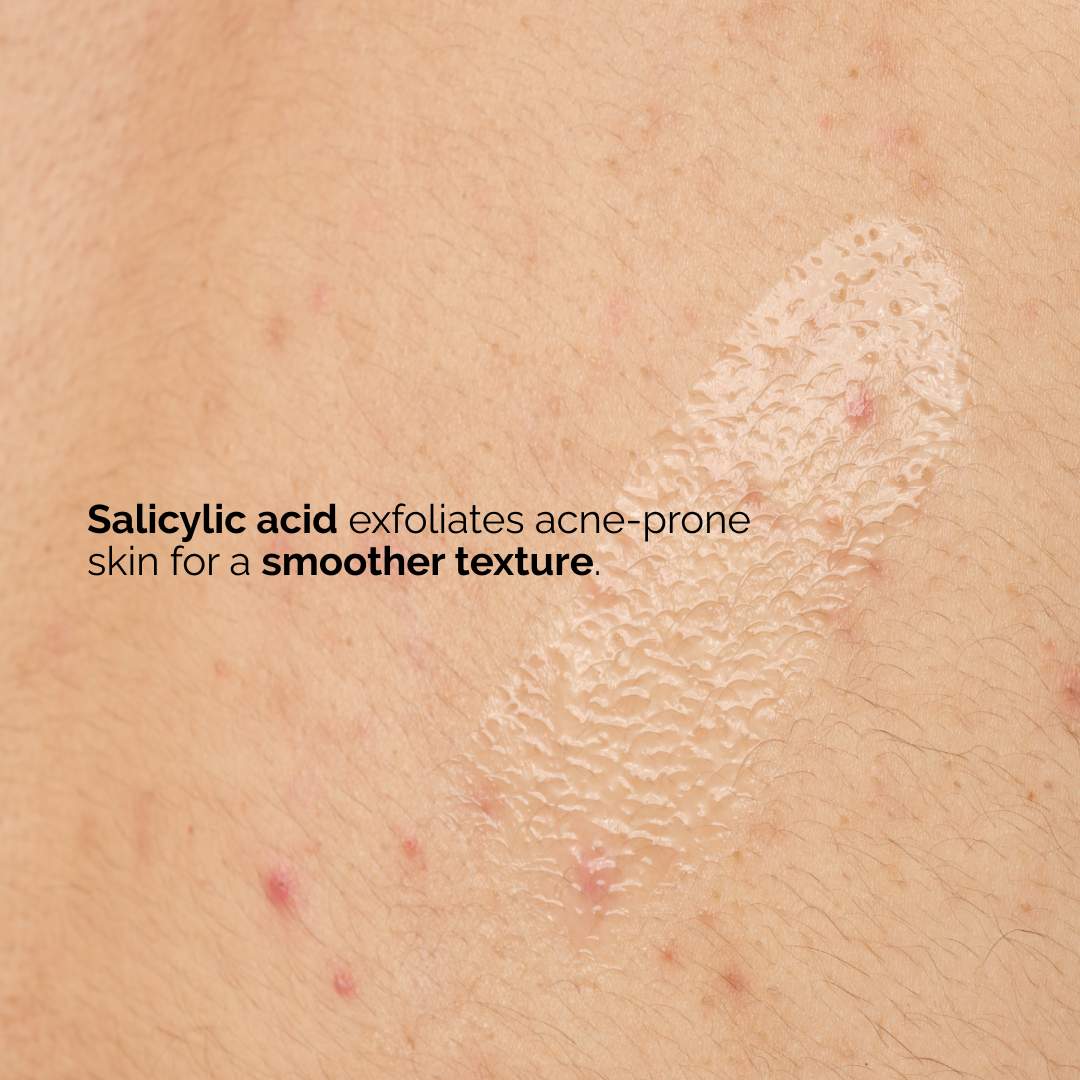 Salicylic Acid 0.5% Body Serum Exfoliating Treatment for Acne