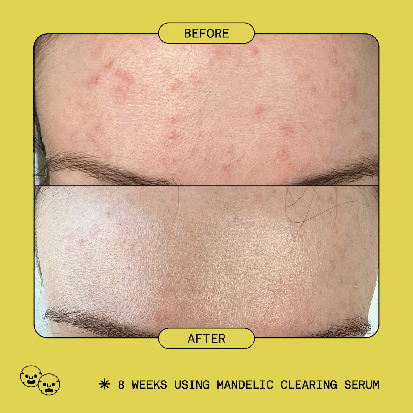 Mandelic Acid Exfoliating & Clearing Serum