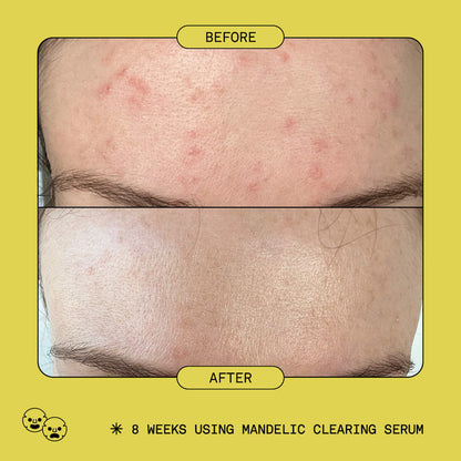 Mandelic Acid Exfoliating & Clearing Serum