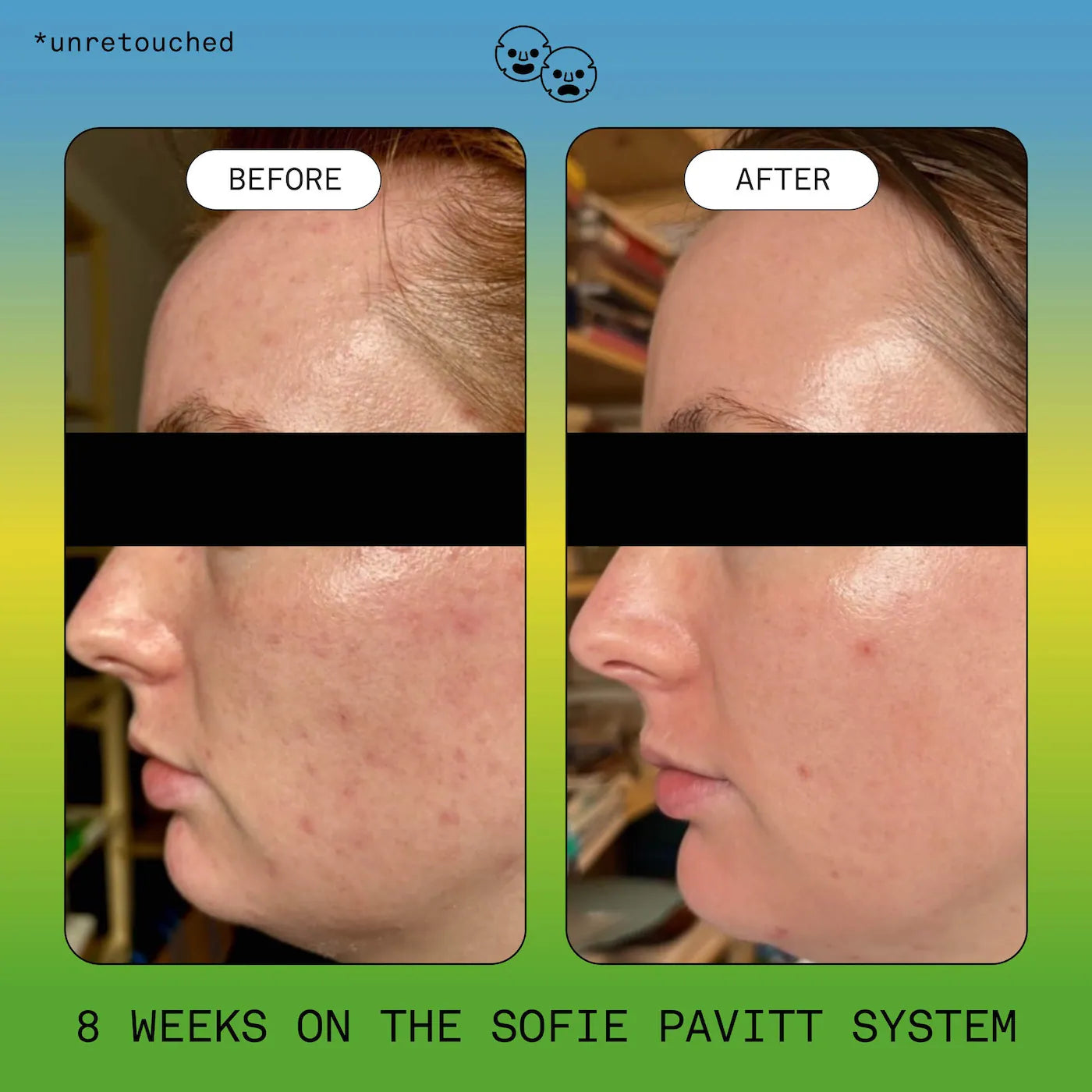Clear Skin Trial Set: Cleanse, Treat, & Hydrate Minis Set
