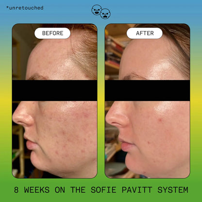 Clear Skin Trial Set: Cleanse, Treat, & Hydrate Minis Set