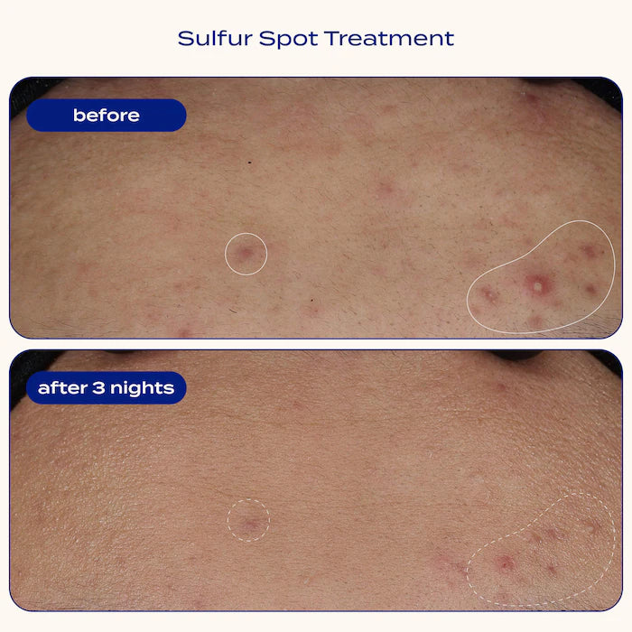 Sulfur Spot Treatment