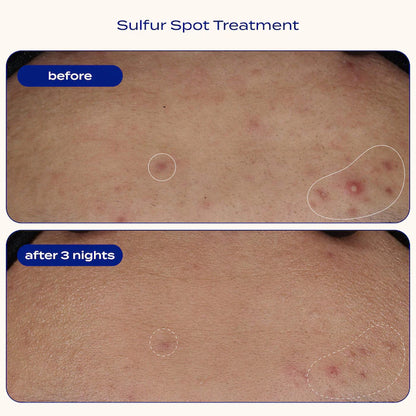Sulfur Spot Treatment