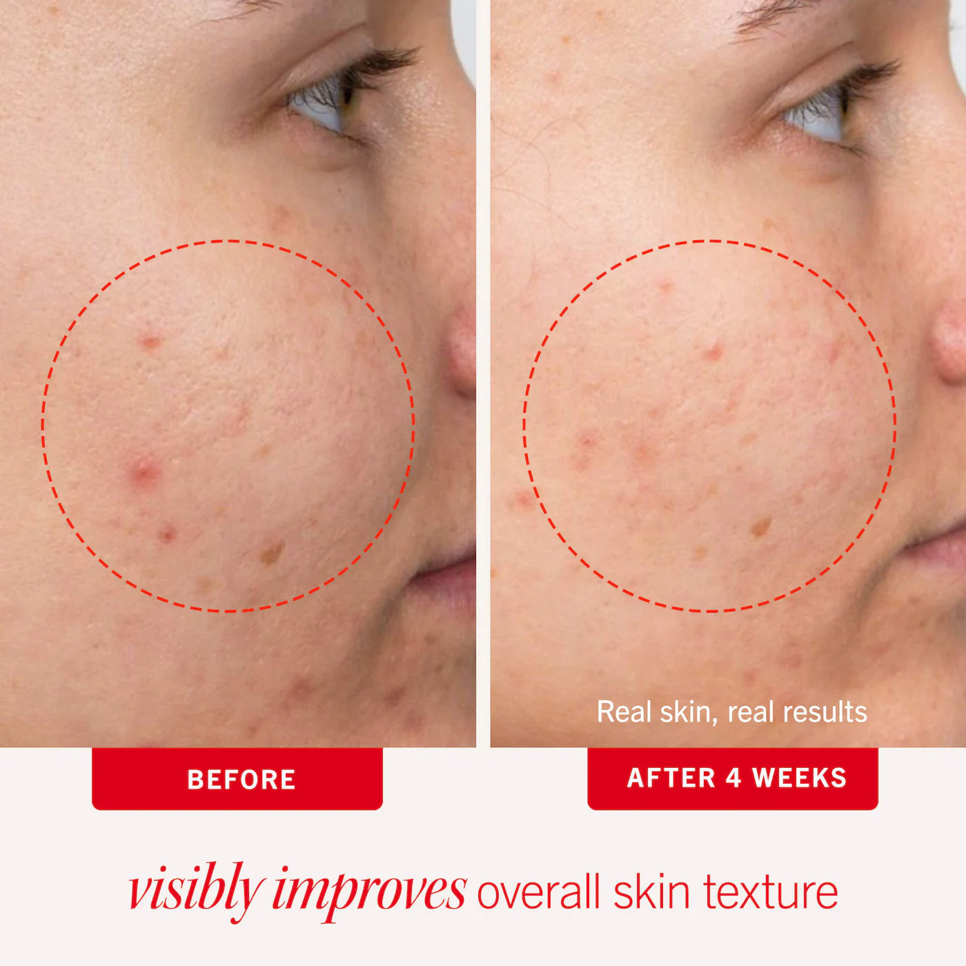 Acne Clearing Pads - 2% Salicylic Acid Acne Treatment