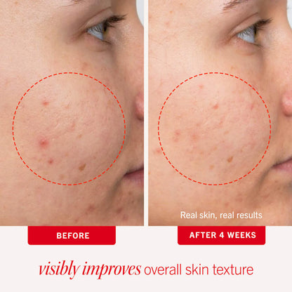 Acne Clearing Pads - 2% Salicylic Acid Acne Treatment
