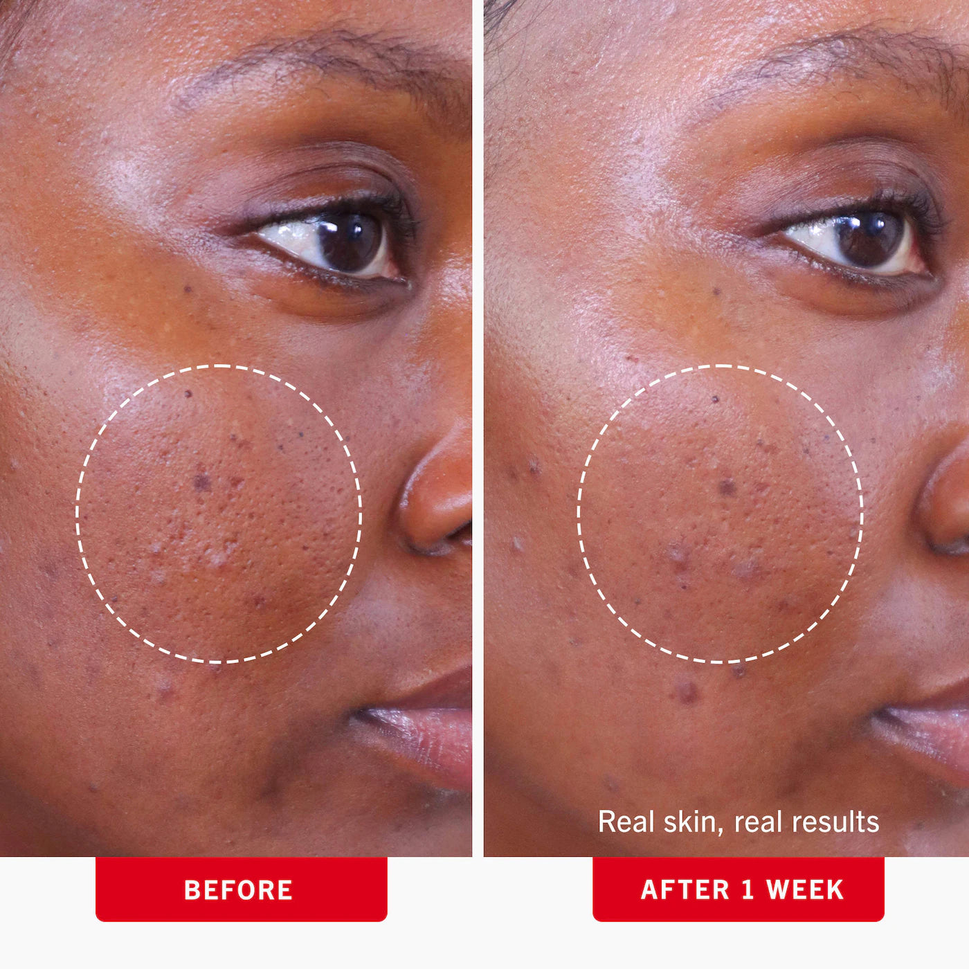 Acne Clearing Pads - 2% Salicylic Acid Acne Treatment