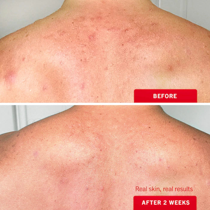 Body Acne Clearing Mist