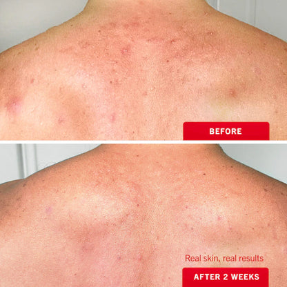 Body Acne Clearing Mist