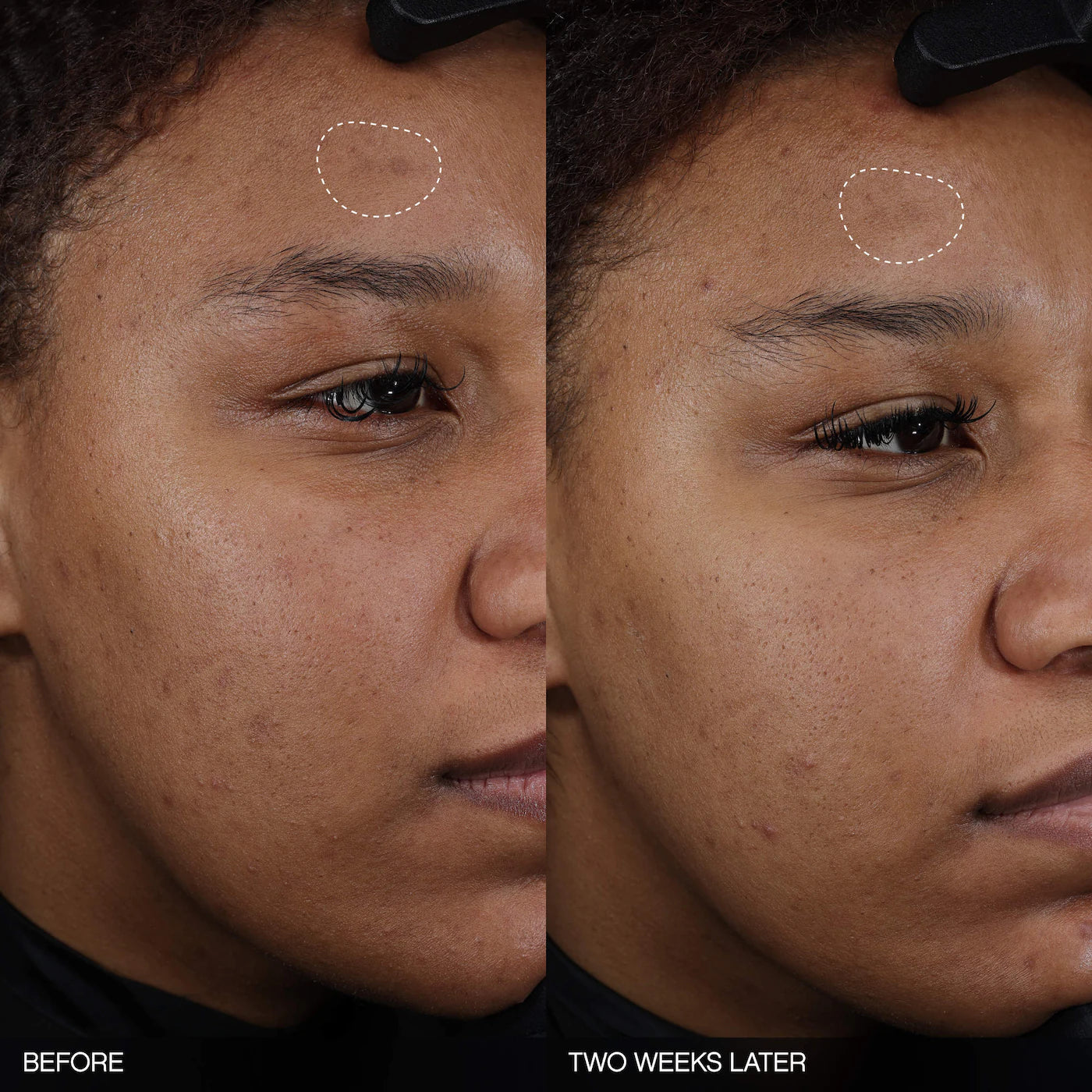 Faded Tranexamic Acid Dark Spot Patches