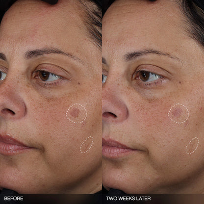 Faded Tranexamic Acid Dark Spot Patches
