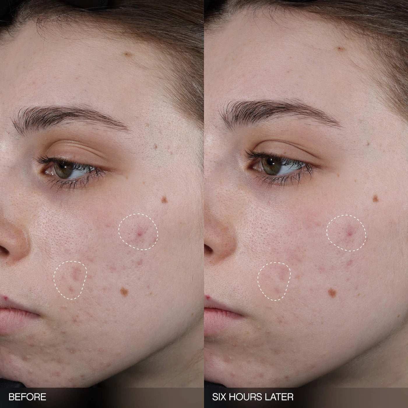Faded Tranexamic Acid Dark Spot Patches