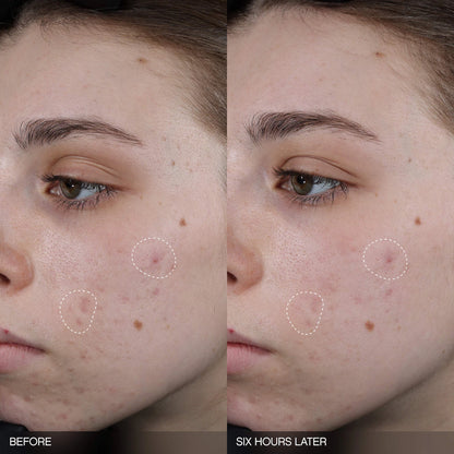 Faded Tranexamic Acid Dark Spot Patches
