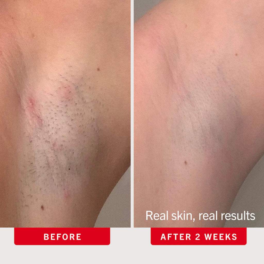 Ingrown Hair Pads with AHA + BHA for Body + Face