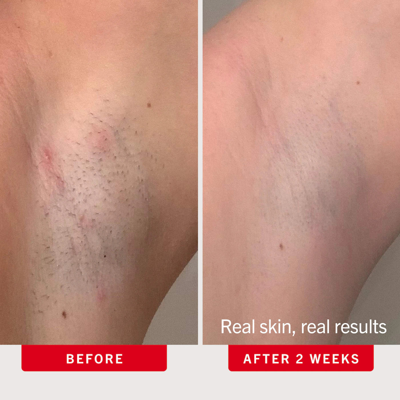 Ingrown Hair Pads with AHA + BHA for Body + Face