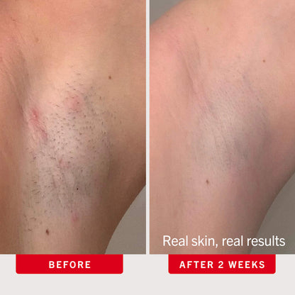 Ingrown Hair Pads with AHA + BHA for Body + Face