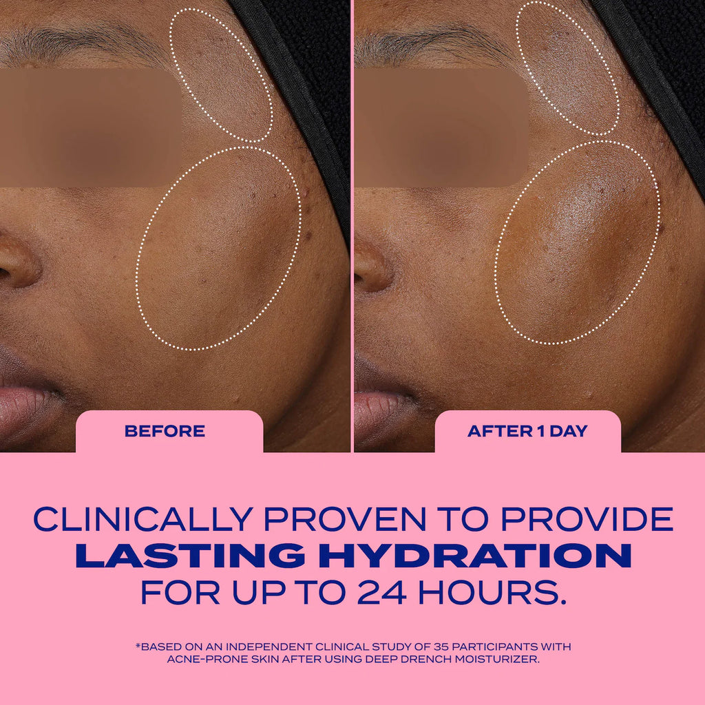 Deep Drench Lightweight Moisturizer for Acne-Prone Skin