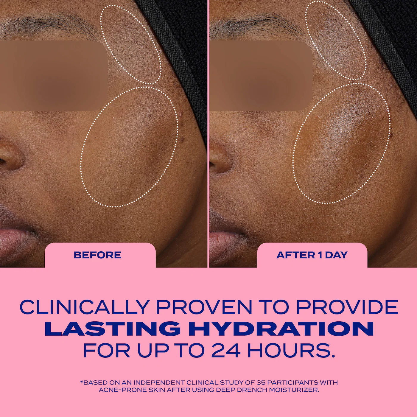 Deep Drench Lightweight Moisturizer for Acne-Prone Skin