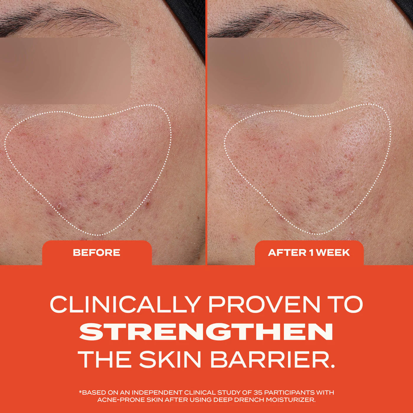 Deep Drench Lightweight Moisturizer for Acne-Prone Skin