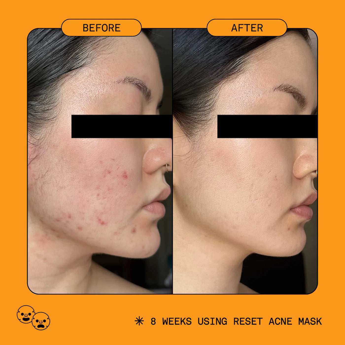 5% Reset Benzoyl Peroxide Acne Treatment with Glycolic Acid