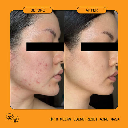 5% Reset Benzoyl Peroxide Acne Treatment with Glycolic Acid