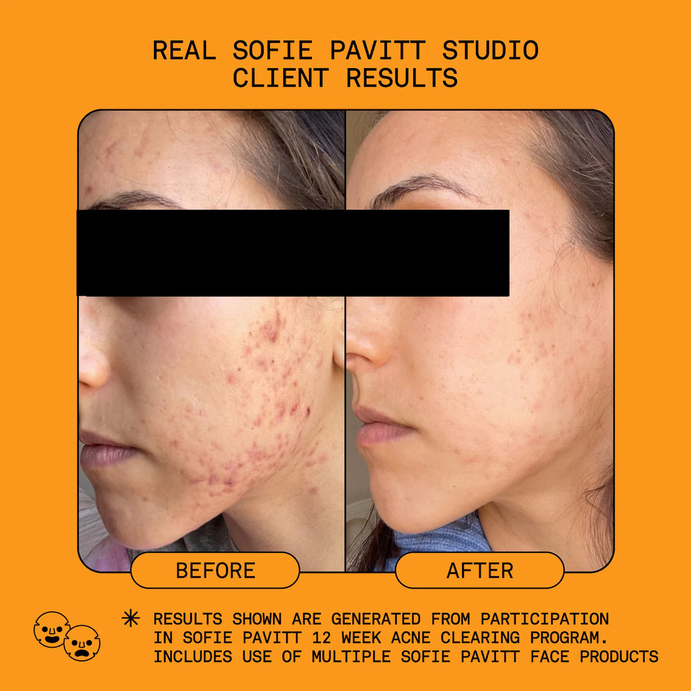 5% Reset Benzoyl Peroxide Acne Treatment with Glycolic Acid